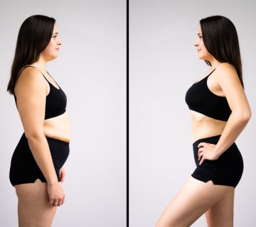 ابدومینوپلاستی