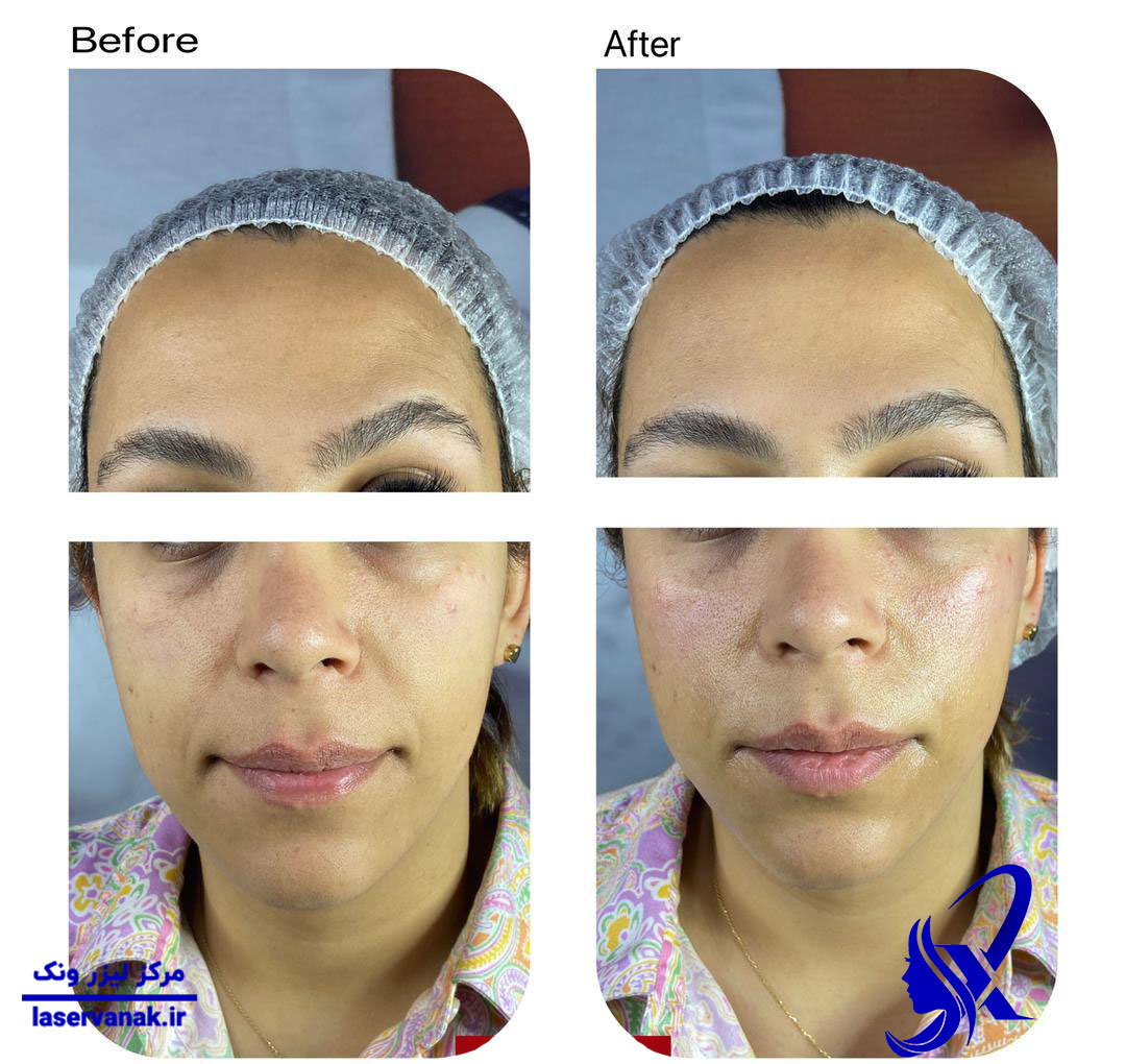 نمونه کار و قبل و بعد تزریق فیلر در ونک